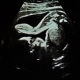 USG - 25 tydzień ciąży