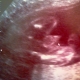 USG - 21 tydzień ciąży