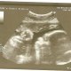 USG - 34 tydzień ciąży
