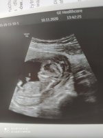 USG - 13 tydzień ciąży